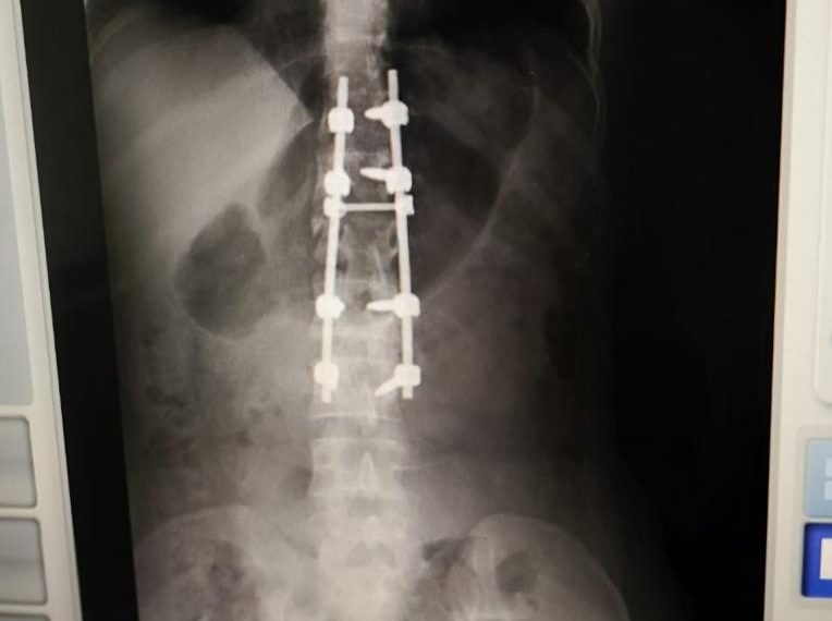 Cirujanos del Gautier esperanzados tras cirugía a mujer sufrió fractura columna