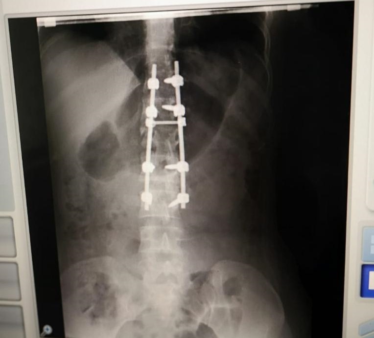 Cirujanos del Gautier esperanzados tras cirugía a mujer sufrió fractura columna